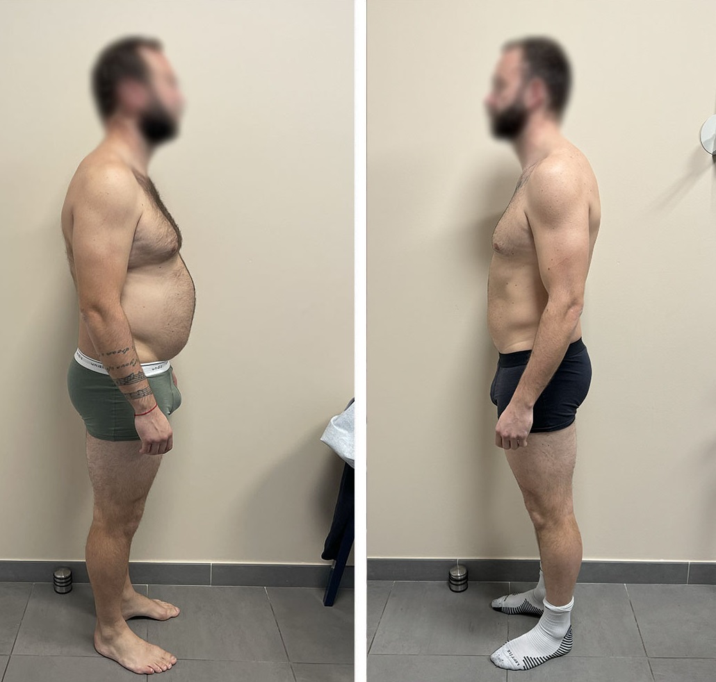 Témoignage Laurent : -35 kg en 10 Mois avec Mounjaro